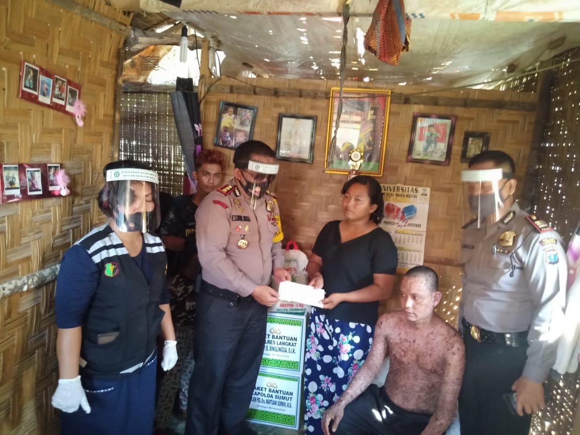 Kapolres Langkat Serahkan Bantuan Kapolda Sumut pada Warga Penderita Sindrom Steven Jhonson